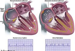 تعریف فیبریلاسیون دهلیزی  به همراه توصیف, علت, نشانه ها تشخیص و درمان