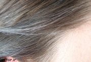 در سفیدشدن موی سر چه عواملی دخالت دارند؟