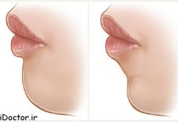 هر آنچه دربار جراحی زیبایی چانه باید بدانید