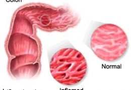 بیماری کولیت – انواع، علائم و درمان