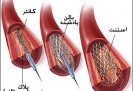 توضیحاتی راجع به مراقبت از کاتتر و فیستول