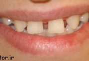 روش های از بین بردن فاصله بین دندانی