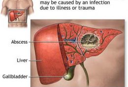 آبسه کبدی – علائم و درمان