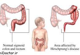 علائم و درمان بیماری هیرشپرونگ