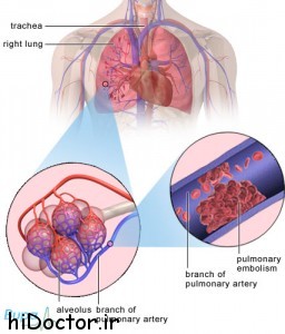 آمبولی ریوی – تشخیص، علائم و درمان