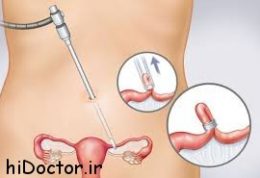 بستن لوله رحم در زنان