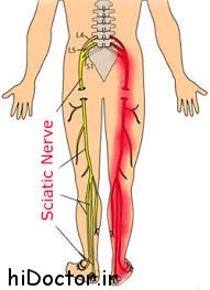 درمان عصب سیاتیک با طب سنتی