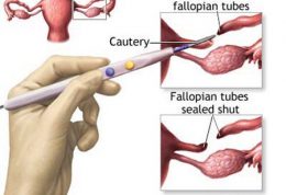 روش بستن لوله های رحمی – خطرات، عوارض جانبی