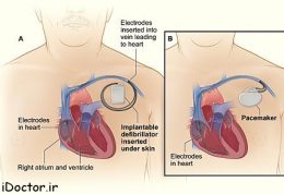 ضربان ساز قلب در چه مواقعی گذاشته میشود؟