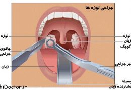 طب سنتی درمورد درمان لوزه چه می گوید