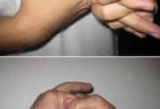 ارتباط شکستن انگشتان با آرتروز زودرس