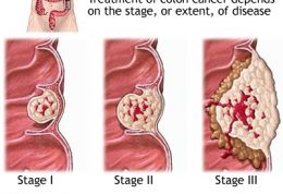 هر آنچه باید درباره سرطان کولورکتال بدانید