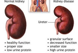 نفروپاتی دیابتی چگونه به کلیه ها آسیب می زند