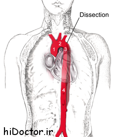 چه کسانی در معرض خطر بیماری دیسکسیون آئورت قرار دارند؟
