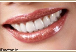 هر آنچه درمورد لامینیت دندان باید بدانید