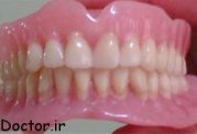 دانستنی هایی درمورد دندان مصنوعی متحرک