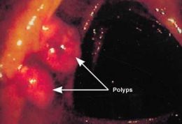 پولیپهای  روده چگونه تشخیص داده می شوند