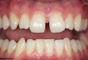 تغییر جای نامعمول دندانها از مشکلات دندانی دوران میانسالی