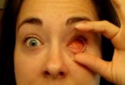 جراحی چشم سرطانی