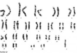 درمورد سندرم ترنر چه میدانید؟
