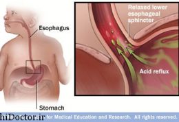 بروز تحریکات عصبی و ریفلاکس معده  نوزاد