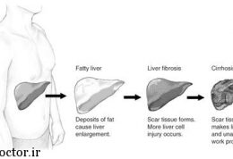 نحوه رژیم گرفتن بیماران کبد چرب