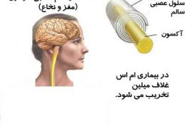 اطلاعات جامع در مورد بیماری ام اس (ms)