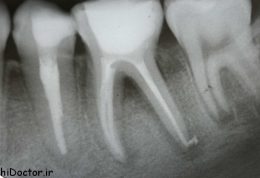 به چه دلیل بعضی وقتها  به ناچار باید دندانمان را مجددا عصب‌کشی کنیم