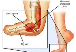 با پیچ خوردن شست و پنجه پا  چکار کنیم