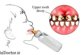عارضه زیاد استفاده از پستانک برای فک و دندانها