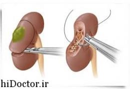 زمانیکه کلیه را از بدن خارج میکنند