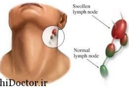 باد کردن غدد لنفاوی به چه دلایلی رخ میدهد؟