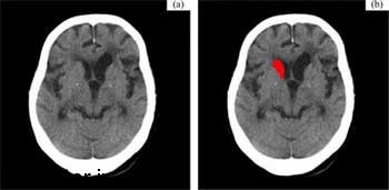 توسط سی تی اسکن سکته مغزی بطور  خودکار تشخیص داده می شود