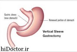 علت موفقیت گاسترکتومی آستین عمودی  تغییرات متابولیسمی روده است