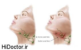 شیوه های معالجه ورم غدد لنفاوی