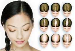 ریختن مو در خانمها: نازک شدن مو علتها  و شیوه های درمان
