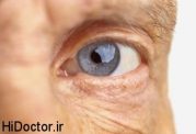  ديابتي ها و عوارض چشمی دیابت
