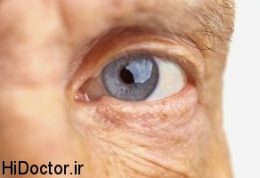 ديابتي ها و عوارض چشمی دیابت