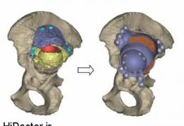 با پرینترهای سه بعدی مفصل مصنوعی ران اختصاصی تولید شد