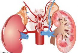 کاهش خطر ایجاد سنگ کلیه با کنترل دیابت