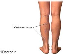از بین بردن رگهای واریسی با درمان هایی طبیعی