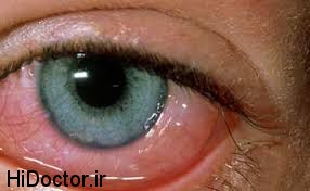 از علائم و نشانه‌ها تا درمان قرمزی چشم