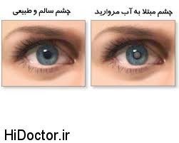 پیشگیری از ایجاد آب مروارید در چشم با این روش ها