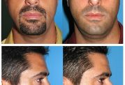 عکس تفاوت های ظاهری قبل و بعد از عمل جراحی زیبایی بینی