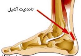 وقتی زردپی متورم می شود