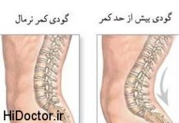 معجزه آسا ترین روش ها برای برطرف کردن گودی کمر