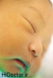 افزایش میزان زردی نوزاد با عرق کردن بیشتر