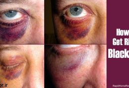 چگونه کبودی چشم ناشی از ضربه را سریع درمان کنیم
