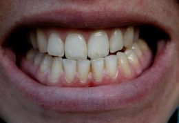 به کمک “لیزر”مینای دندان هم درمان می شود