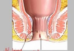علت ایجاد شقاق مقعدی و درمان آن